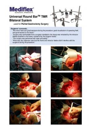 System Round Bar BILATERAL in Partial Gastrectomy